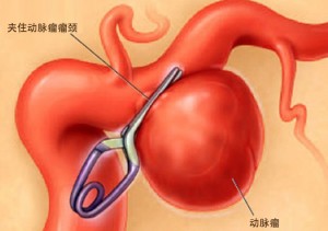 头痛两个月,查出脑动脉瘤,千里迢迢回东阳