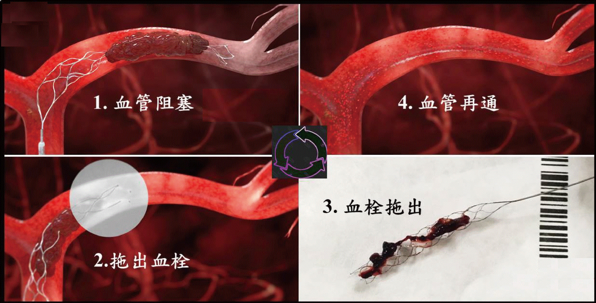 脑血管介入诊疗技术简介