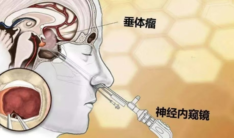 垂体瘤团队