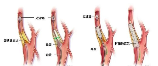 脑卒中团队